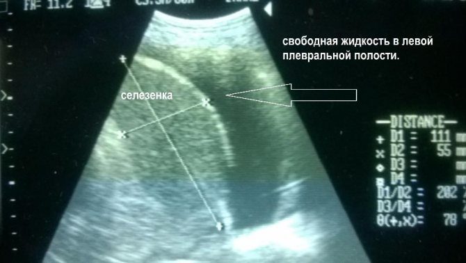 УЗИ плевральной полости